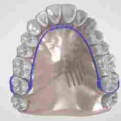 CRIB HABIT BREAKER WITH SPIKES DENTAL APPLIANCE ON UPPER TEETH