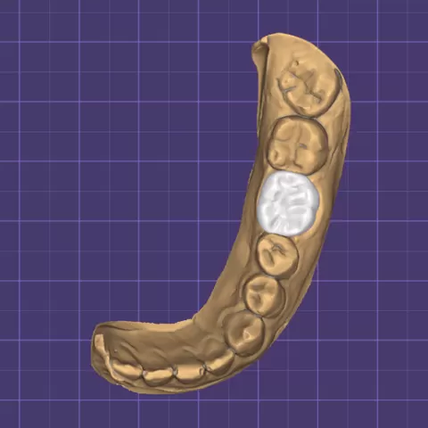 MONOLITHIC ZIRCONIUM CROWN #1
