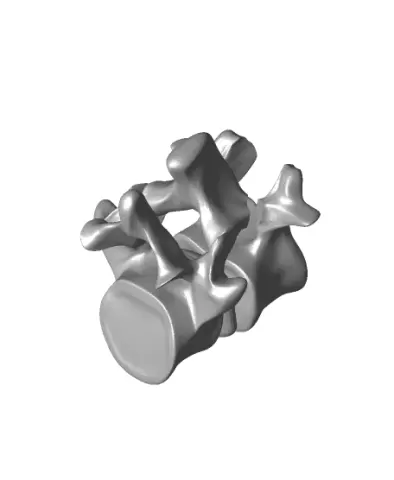 Spondy grade 1 bennett models.stl