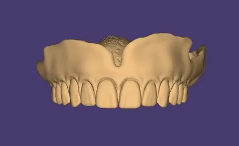 TOTAL REMOVABLE DENTURE upper + FLEXI PARTIAL DENTURE lower ( total 11 stl files)
