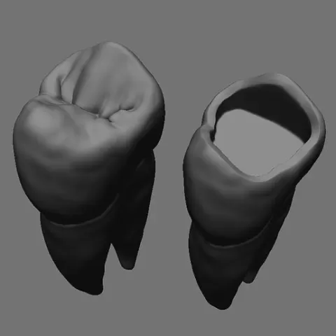 maxillary first premolar \\ occlusal restoration model