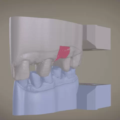 Digital Implant Model with Soft Tissue
