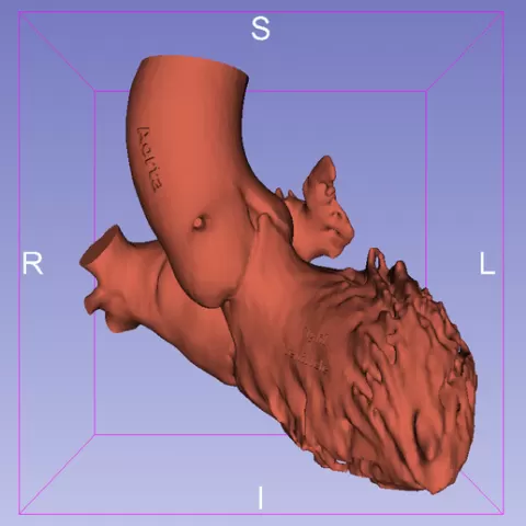 Right Heart Bloodpool Volume