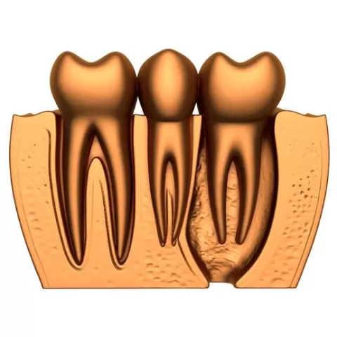 dental implant / dental implant stl / implant printer / Teeth Dental Implants / Tooth / Tooth stl