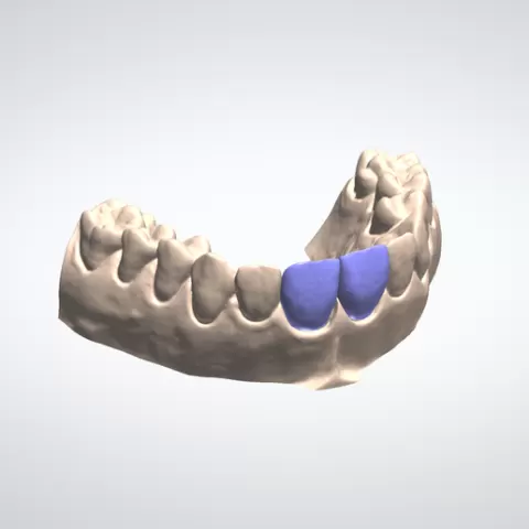 Veneer MODELS